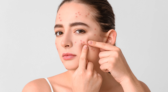 Explore effective acne treatment at aroga pharmacy in farnham common