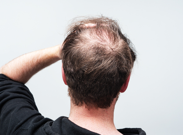 Get effective male pattern hair loss treatment in farnham royal