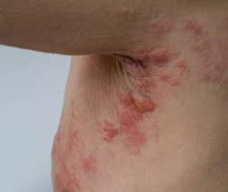 Shingles treatment in Taplow