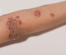 Impetigo treatment in Stoke Poges