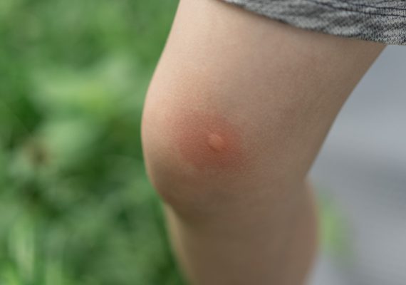 Infected Insect Bite in Farnham Common