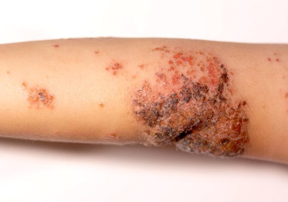 Best treatment for impetigo