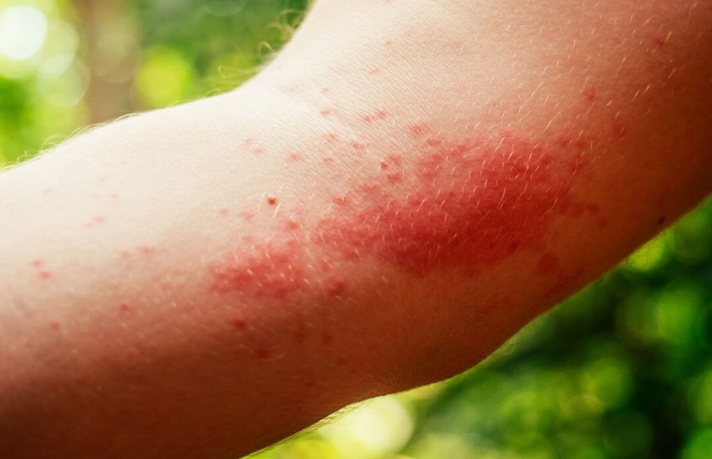 Infected insect bites treatment in Slough