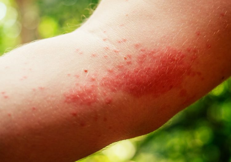 Infected insect bites treatment in Slough