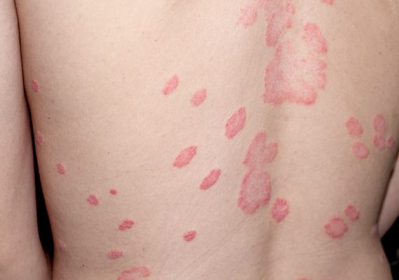 Best treatment for Shingles