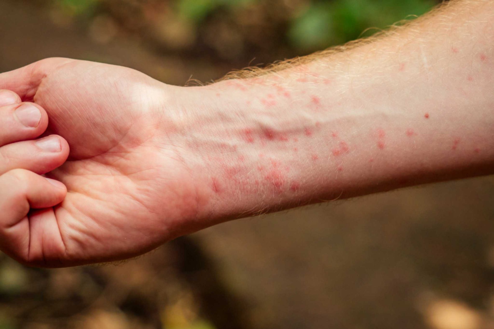 How to Relieve Itching From Insect Bites? Aroga Pharmacy