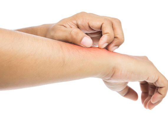 Insect bites treatments