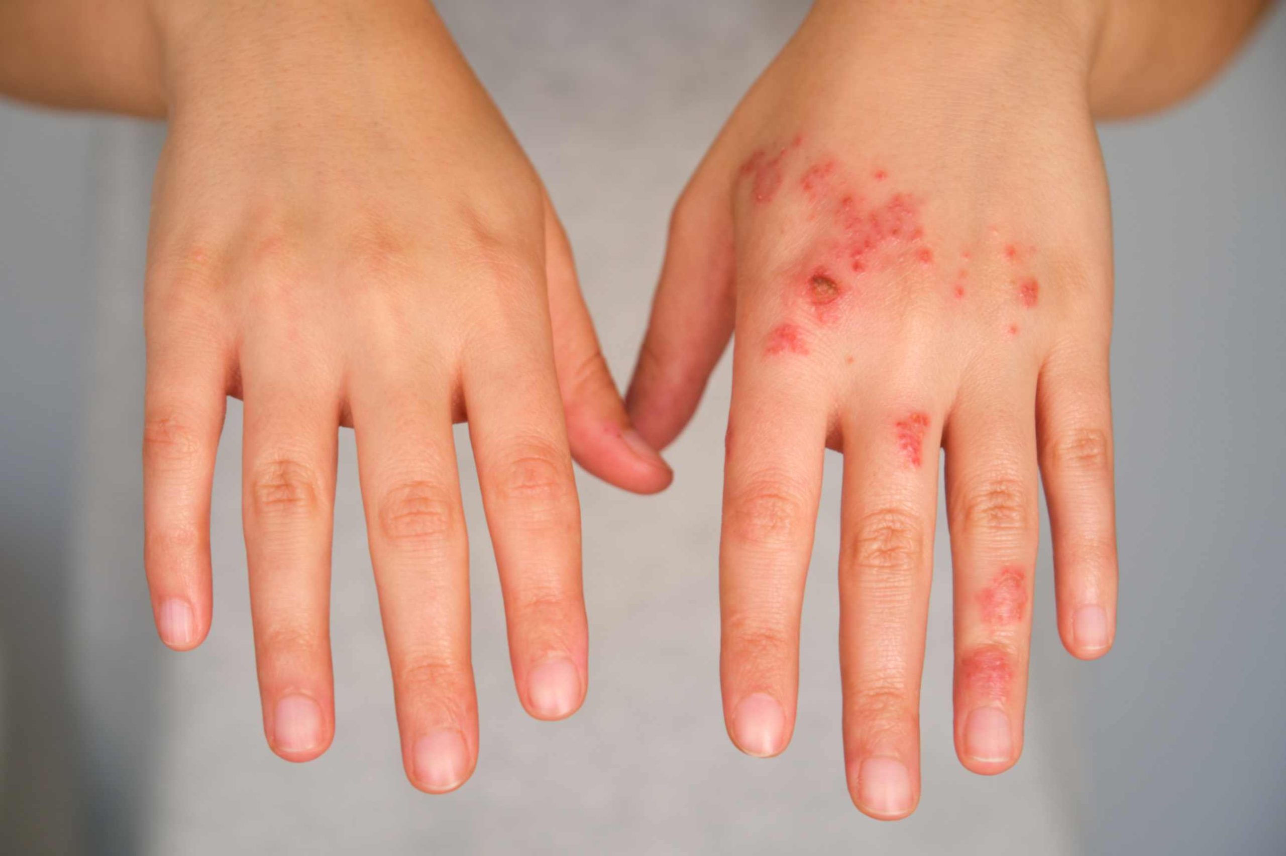 So erkennen Sie die frühen Symptome von Impetigo - Aroga Pharmacy