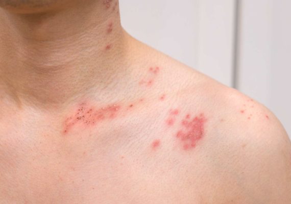 Shingles symptoms and treatment
