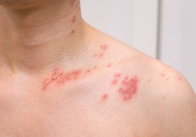 Shingles symptoms and treatment