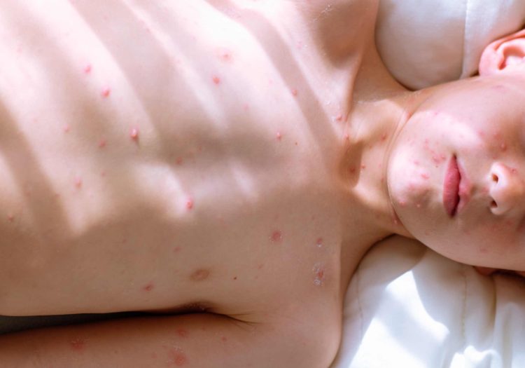 Shingles vs. Chickenpox