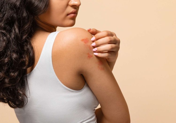 Shingles treatment in Gerrards Cross