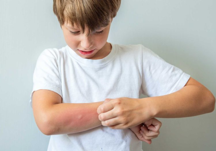 Infected insect bite treatment in Slough