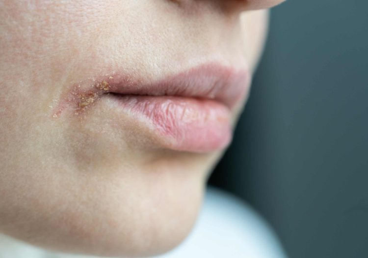 Impetigo contagious