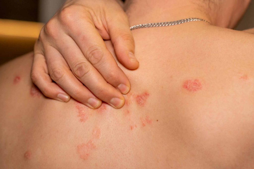 Shingles pain relief