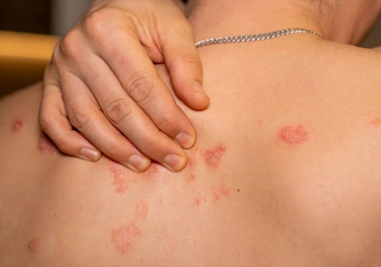 Shingles pain relief