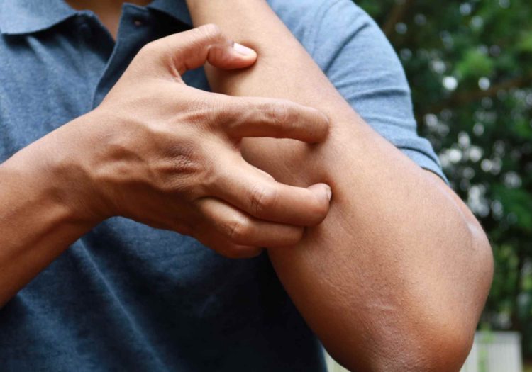Tips to reduce mosquito bite itching and swelling