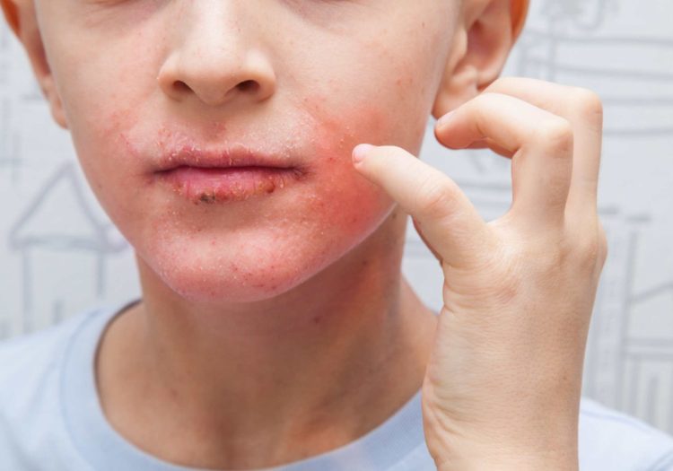 How long does impetigo last