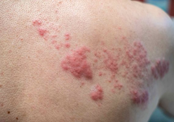 shingles treatment in Fulmer at Aroga Pharmacy