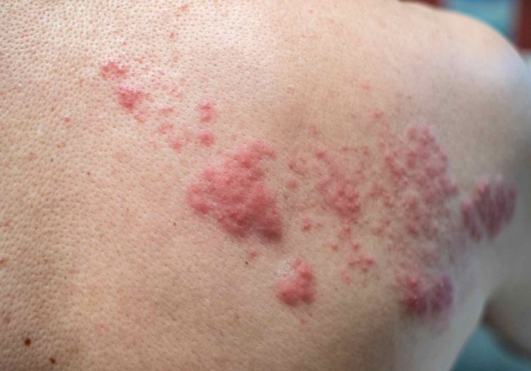 shingles treatment in Fulmer at Aroga Pharmacy