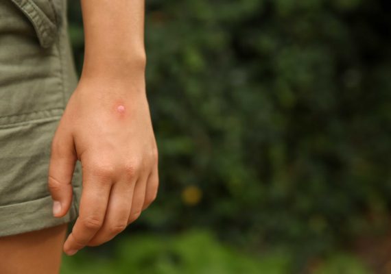 Skin infection caused by insect bite symptoms