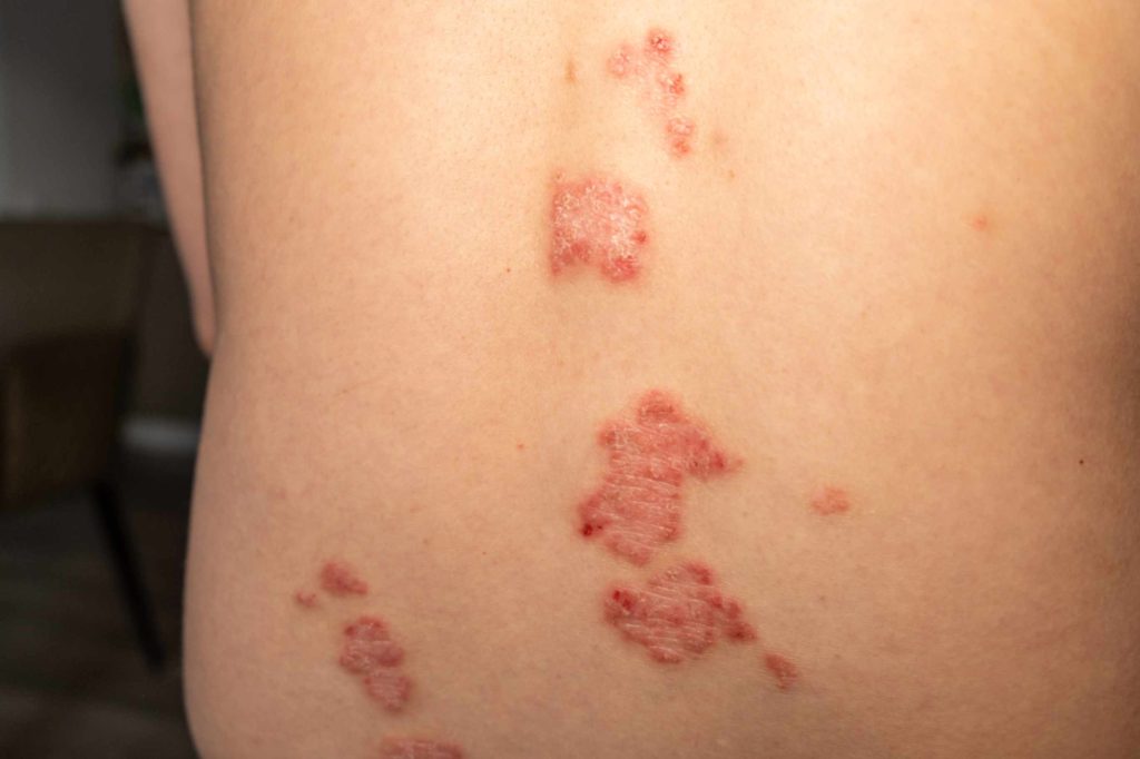 Warning signs of shingles infection on skin