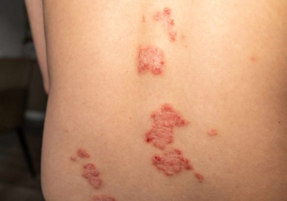 Warning signs of shingles infection on skin
