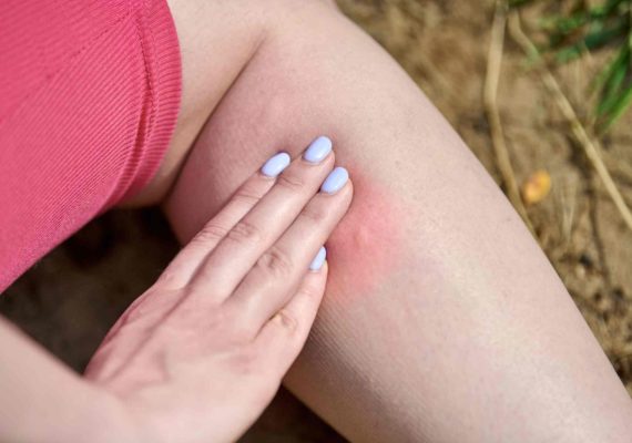 close-up of mosquito bite on human skin