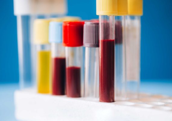 Blood Tests Should You Have in Your 40s