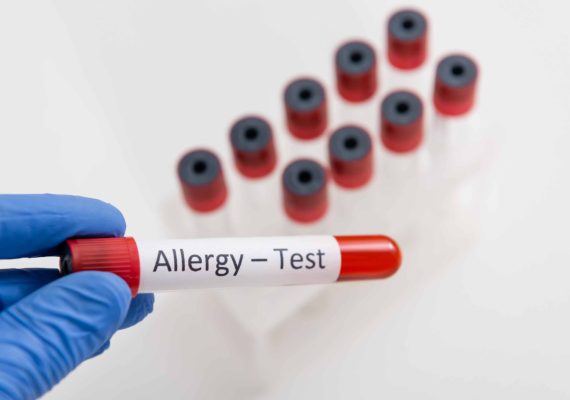 Allergy Blood Tests UK: Identify Food & Environmental Triggers