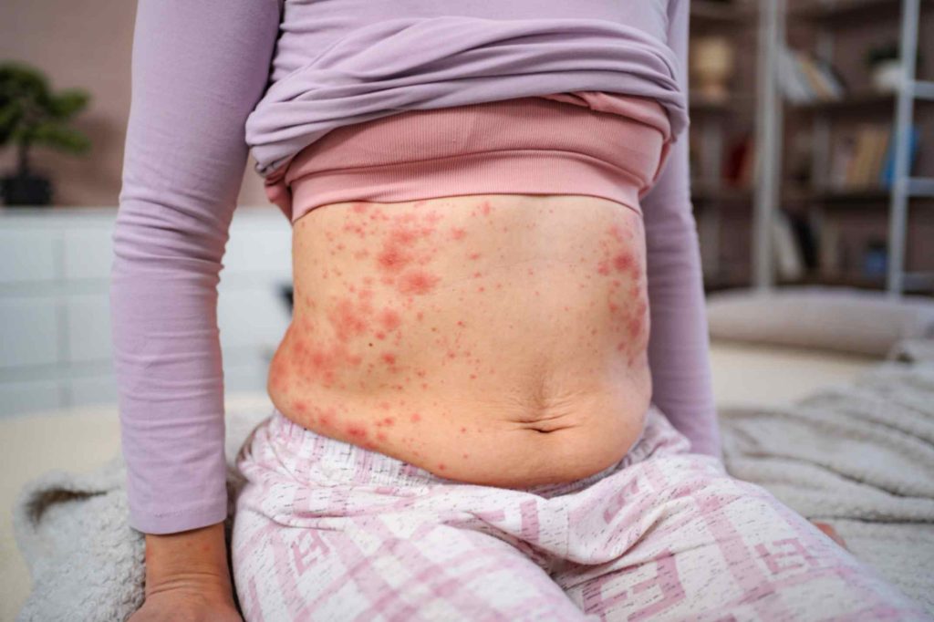 Shingles in the Elderly