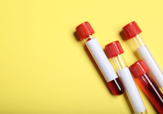 Vitamin Deficiency Blood Tests: B12, Vitamin D & Iron Explained