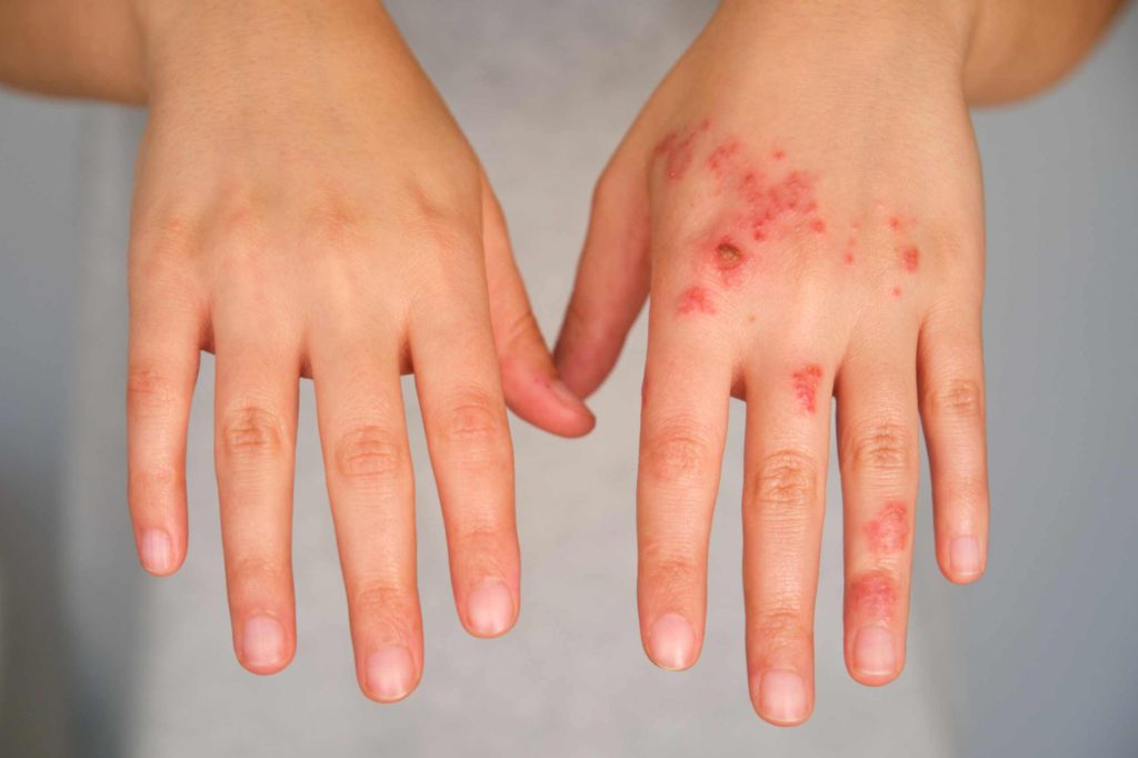 signs of impetigo