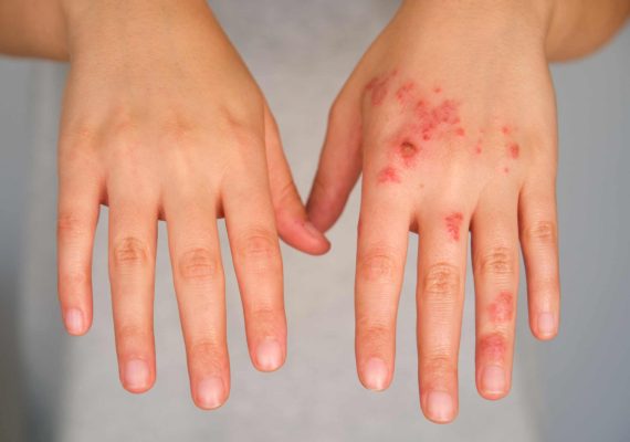 signs of impetigo