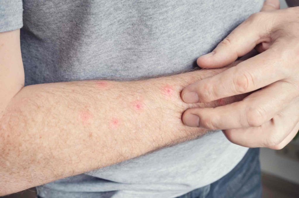 Insect bite swelling treatment