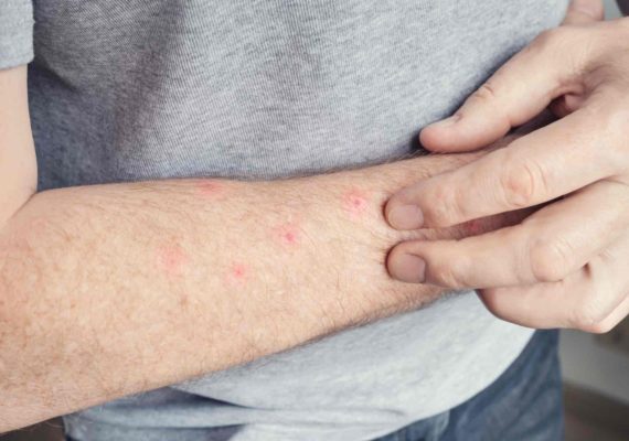 Insect bite swelling treatment